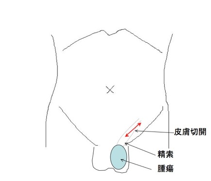 精巣にしこりがある