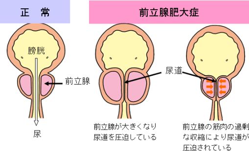 BPH模式図