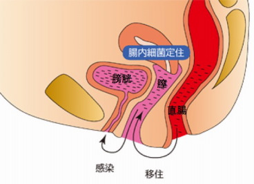 膀胱炎小