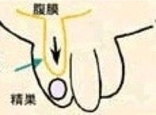 腹膜鞘状突起（１）