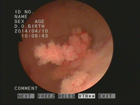 膀胱腫瘍